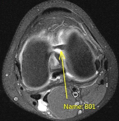 Figure 6 for case Unstable displaced lateral meniscus flap tear( RID2763 )